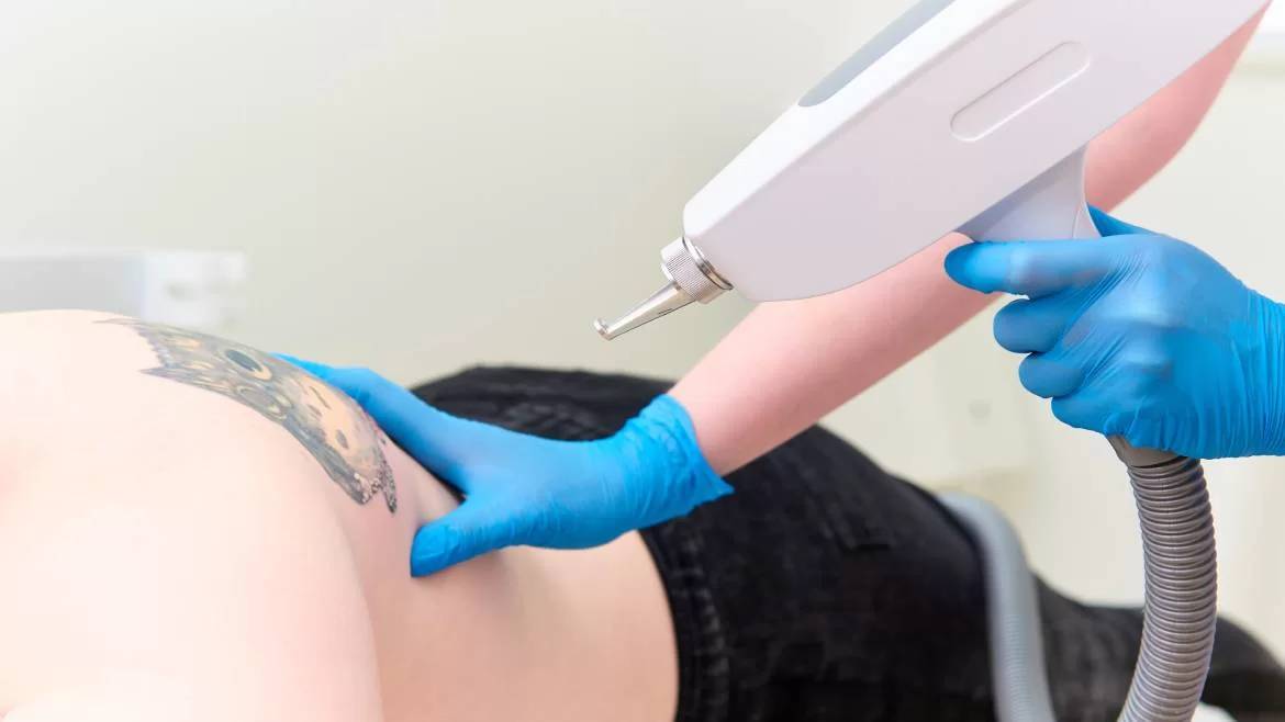 Dövme Silme İşlemi