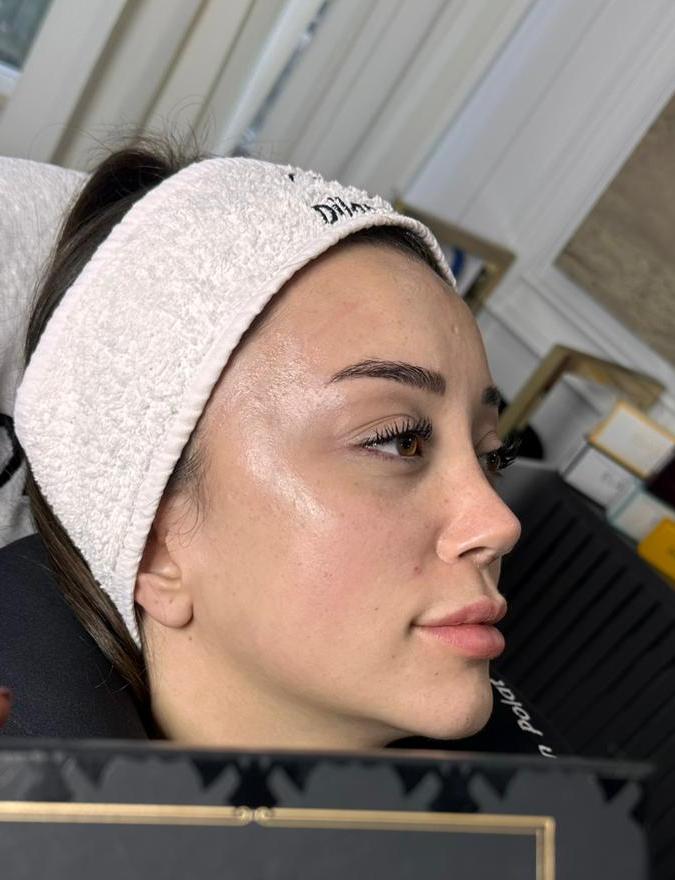 Gözaltı Işık Dolgusu